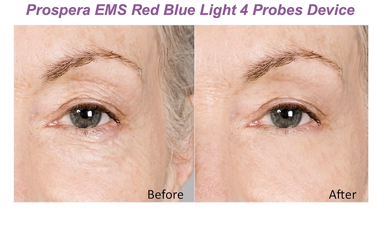 Prospera Prosepra Ems Red Blue Light 4 Probes Beauty Device