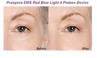 Prospera Prosepra Ems Red Blue Light 4 Probes Beauty Device