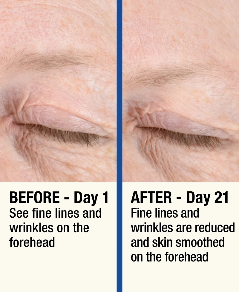7LS by HoMedics ReMOVE Micro Dermabrasion Device with Cooling Surface