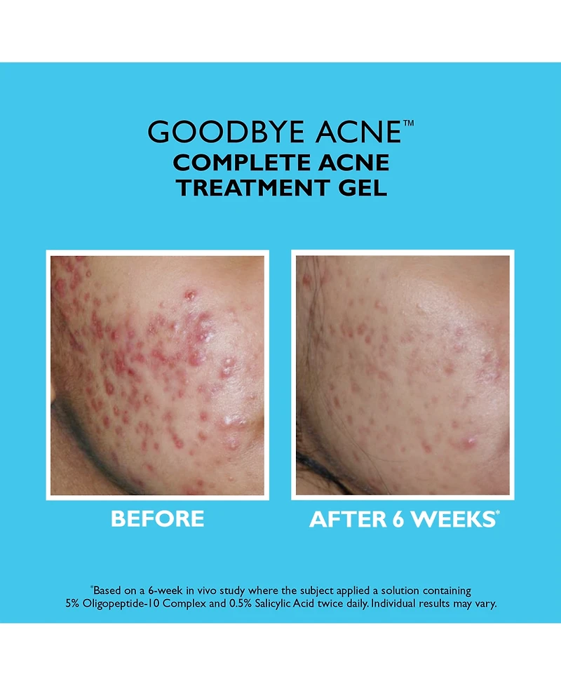 Peter Thomas Roth Goodbye Acne Complete Acne Treatment Gel