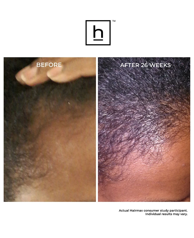 HairMax Laserband 41 Comfortflex