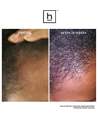 HairMax Laserband 41 Comfortflex