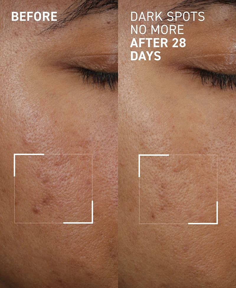 Dr. Brandt Dark Spots No More Triple Acid Spot Minimizing Concentrate, 0.5 oz.