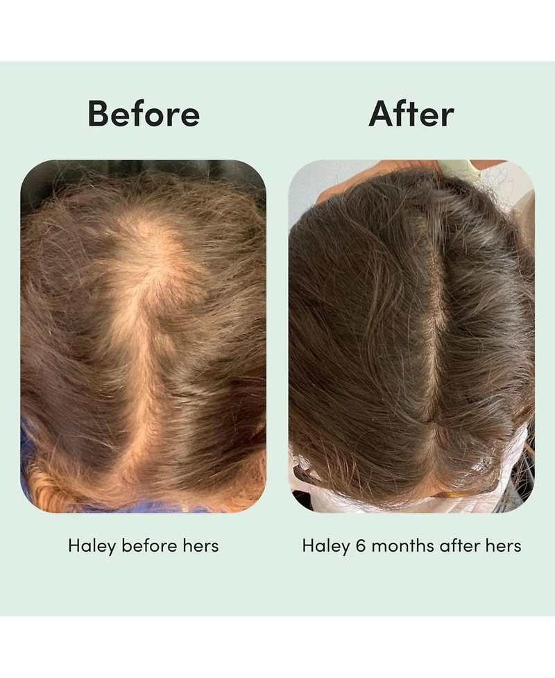 Hers Hair Regrowth Treatment Minoxidil 2% Topical Serum