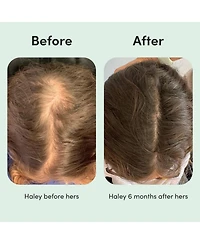Hers Hair Regrowth Treatment Minoxidil 2% Topical Serum