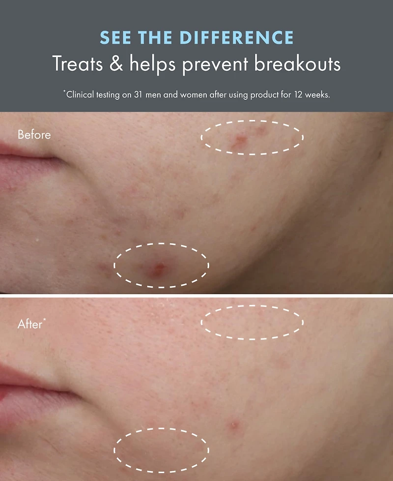 Origins Clear Improvement Acne Clearing Hydrating Lotion, 1.7 oz.