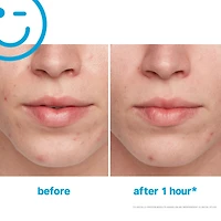 EradiKate™ Acne Spot Treatment with 10% Sulfur