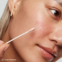 EradiKate™ Acne Spot Treatment with 10% Sulfur