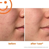 Soin exfoliant intensif ExfoliKate™