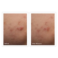 Rapid Relief Acne Spot Treatment