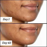 U.F.O. Soin pour le visage en huile avec acide salicylique (ABH)