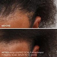 GloPRO® Microneedling & Healthy Scalp Hair Density Treatment Set