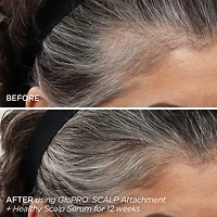 GloPRO® Microneedling & Healthy Scalp Hair Density Treatment Set