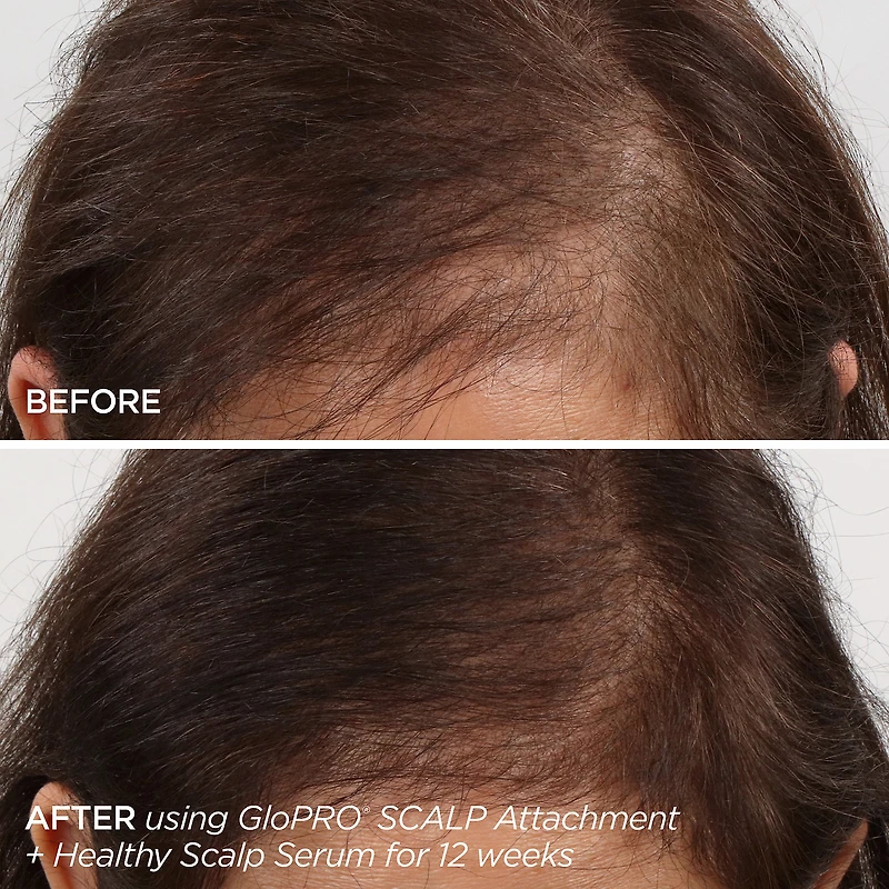 GloPRO® Microneedling & Healthy Scalp Hair Density Treatment Set