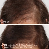 GloPRO® Microneedling & Healthy Scalp Hair Density Treatment Set