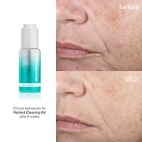 Retinol Acne Clearing Oil