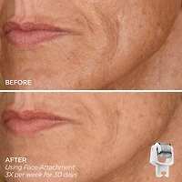 Eye Want It All Face + Eye Microneedling Set
