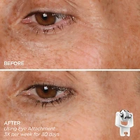 Eye Want It All Face + Eye Microneedling Set