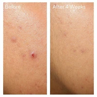 Clarifying Water Gel Moisturizer with Hyaluronic Acid