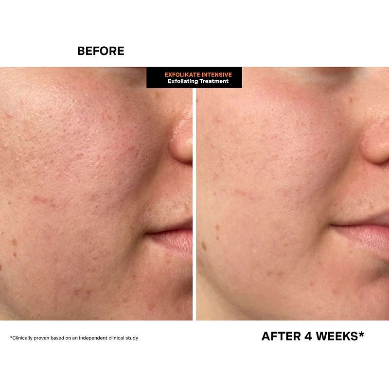 ExfoliKate™ Intensive Exfoliating Treatment