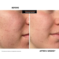 ExfoliKate™ Intensive Exfoliating Treatment