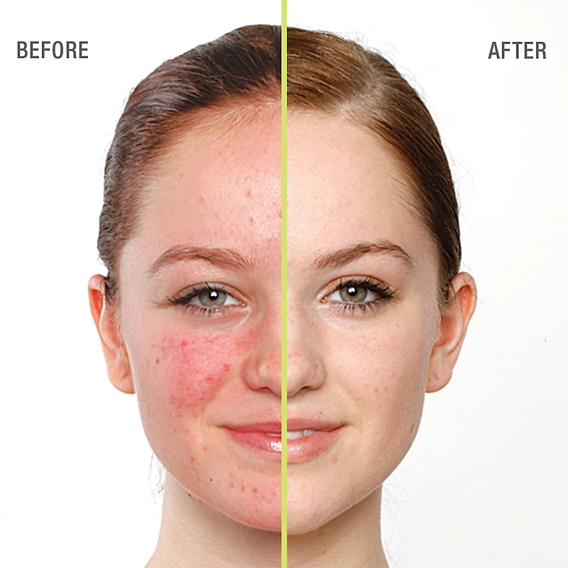 Gel nettoyant anti-imperfections