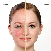 Gel nettoyant anti-imperfections
