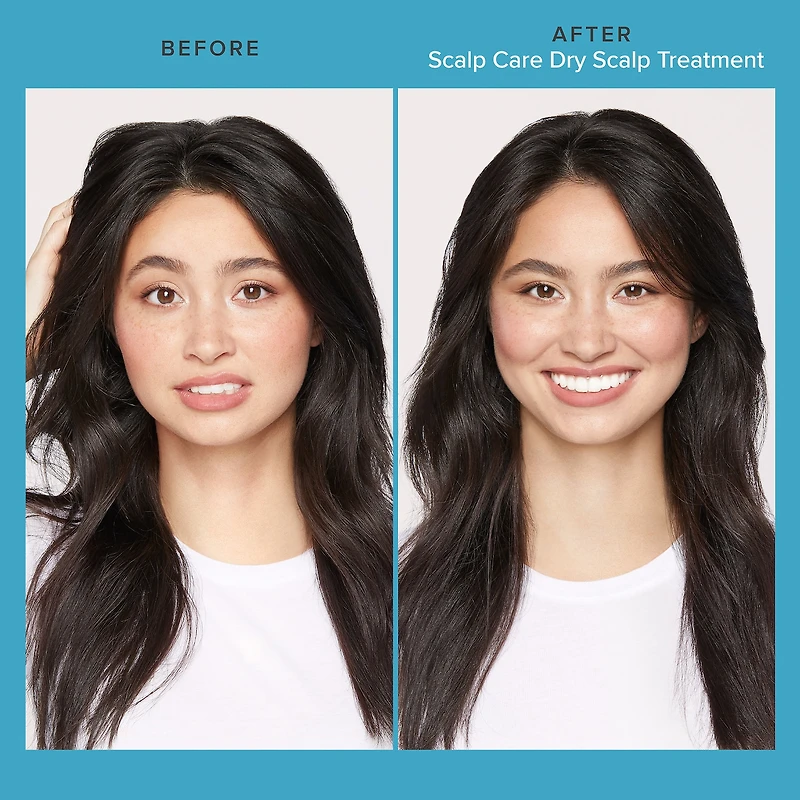 Scalp Care Dry Scalp Treatment