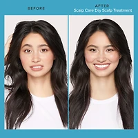 Scalp Care Dry Scalp Treatment