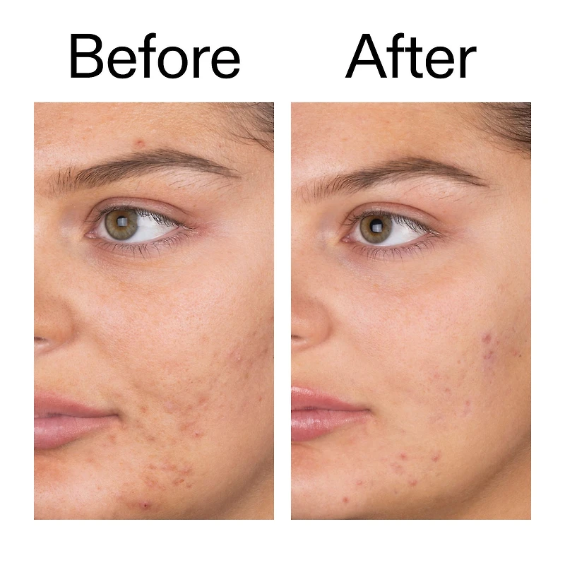 Salicylic Acid Acne + Blackhead Cleanser