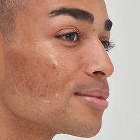 Tranexamic Acid Hyperpigmentation Treatment