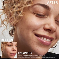 Apple Cider Vinegar Acid Peel