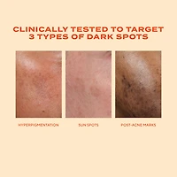 Rapid Dark Spot Correcting Serum with Glycolic and Tranexamic Acid