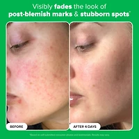 10% Azelaic Acid Booster for Redness Relief