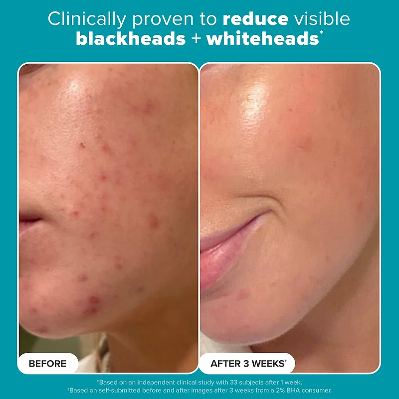 Skin Perfecting 2% BHA Exfoliating Toner for Clear