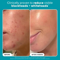 Skin Perfecting 2% BHA Exfoliating Toner for Clear