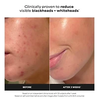 Mini Skin Perfecting 2% BHA Exfoliating Toner for Clear Skin