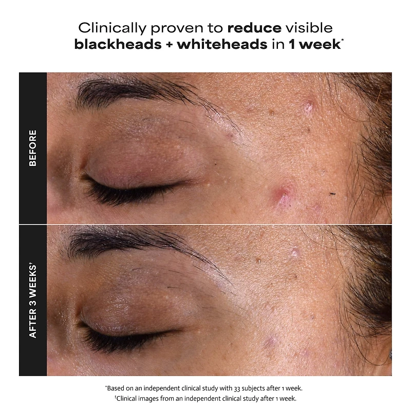 Mini Skin Perfecting 2% BHA Exfoliating Toner for Clear Skin