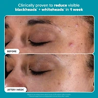 Skin Perfecting 2% BHA Exfoliating Toner for Clear