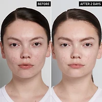 Succinic Acid Treatment