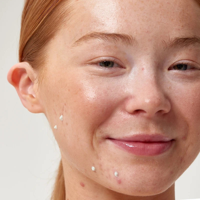 Succinic Acid Treatment
