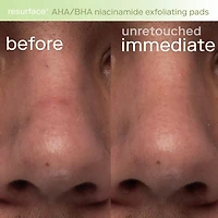 Resurface+ AHA/BHA Niacinamide Exfoliating Pads for Face and Targeted Body