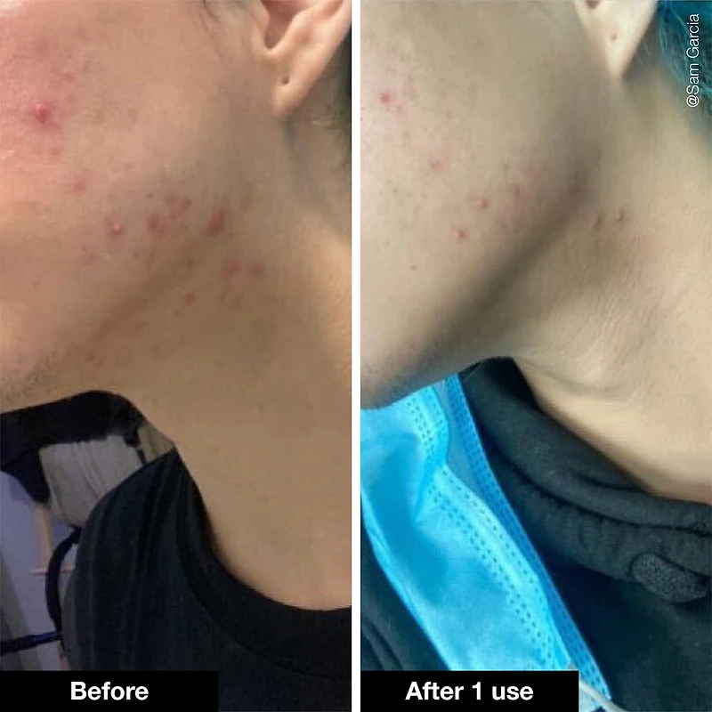 Pimple Paste Overnight Blemish Spot Treatment