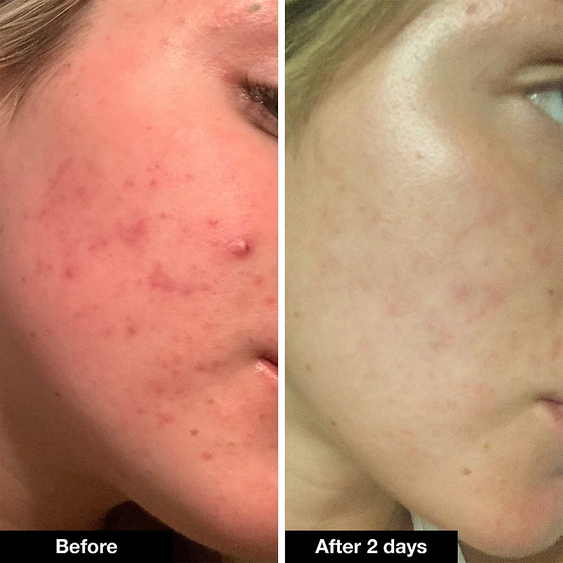 Pimple Paste Overnight Blemish Spot Treatment