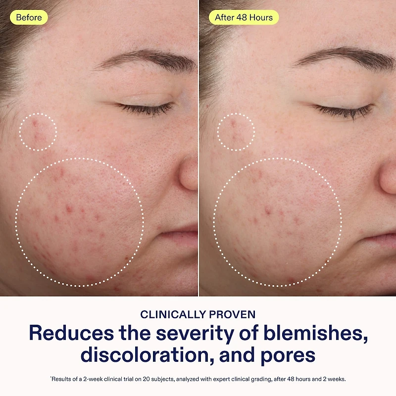 Acne+ 2% BHA + Azelaic Acid + Niacinamide + AHA Cleanser