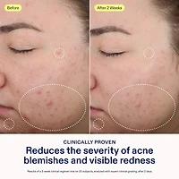 Acne+ 2% BHA and Azelaic Acid Acne Spot Treatment