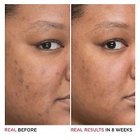 Sérum de niacinamide 4 % Bye Bye Dark Spots