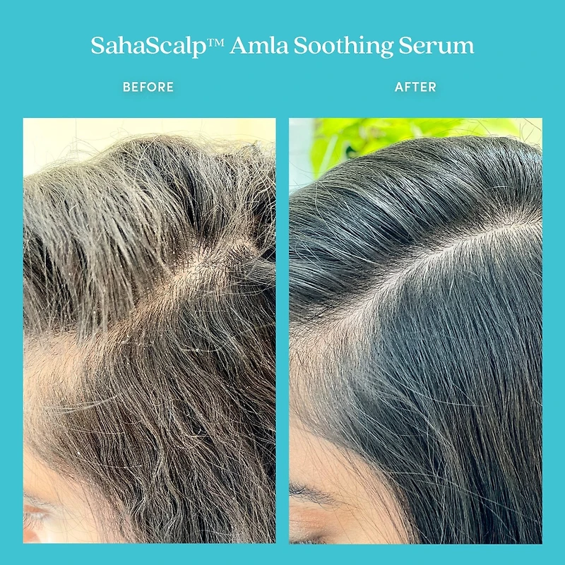 Sérum apaisant à l’amla SahaScalp™
