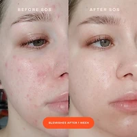 Sérum intensif Anti-Rougeurs SOS avec acide hypochloreux