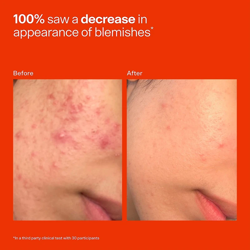 SOS Daily Hypochlorous Acid Spray for Breakouts & Redness